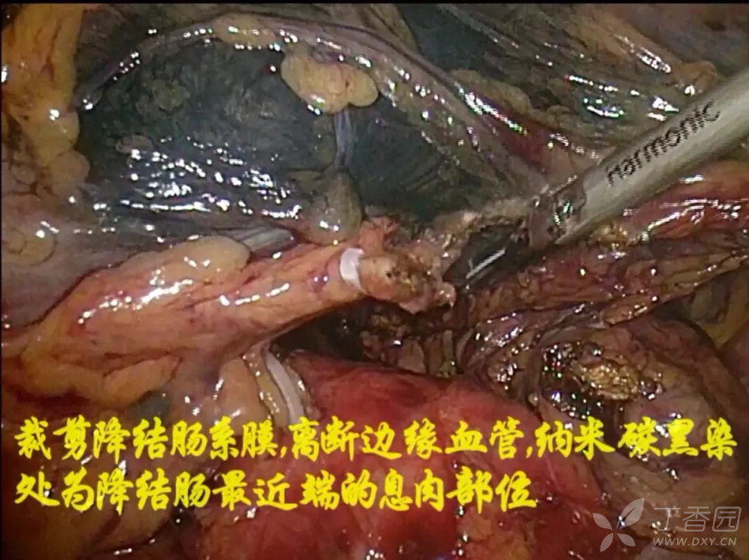 一场撸肠子的干货手术,99.9%的人没见过!