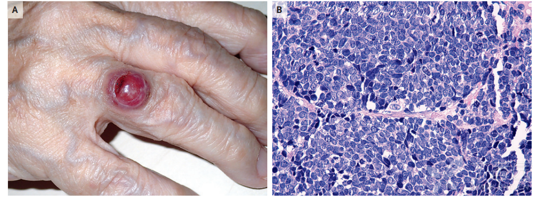 梅克尔细胞癌【nejm读片挑战】 - 皮肤与性传播疾病讨论版 -丁香园论