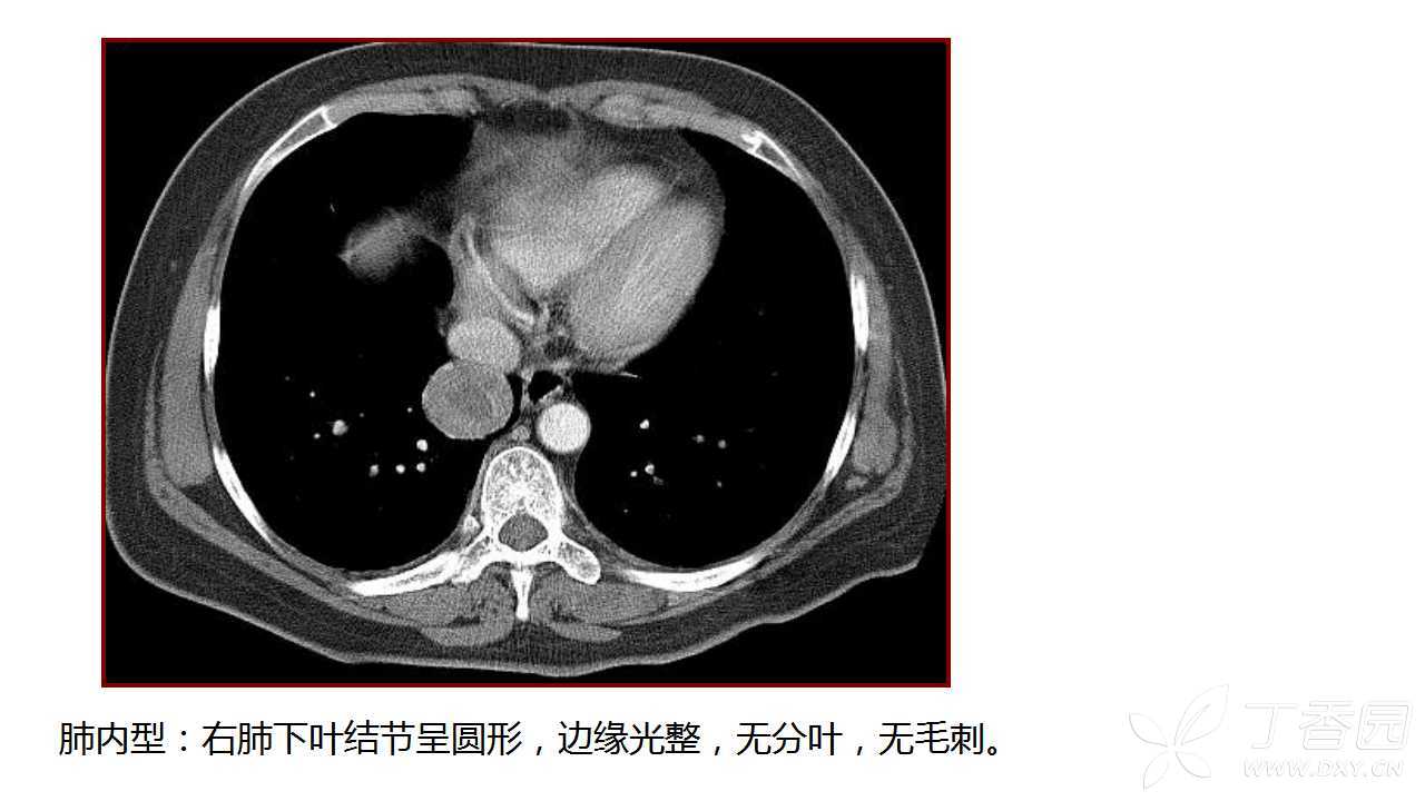 肺部错构瘤图片