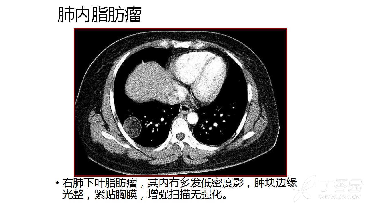 肺部错构瘤图片