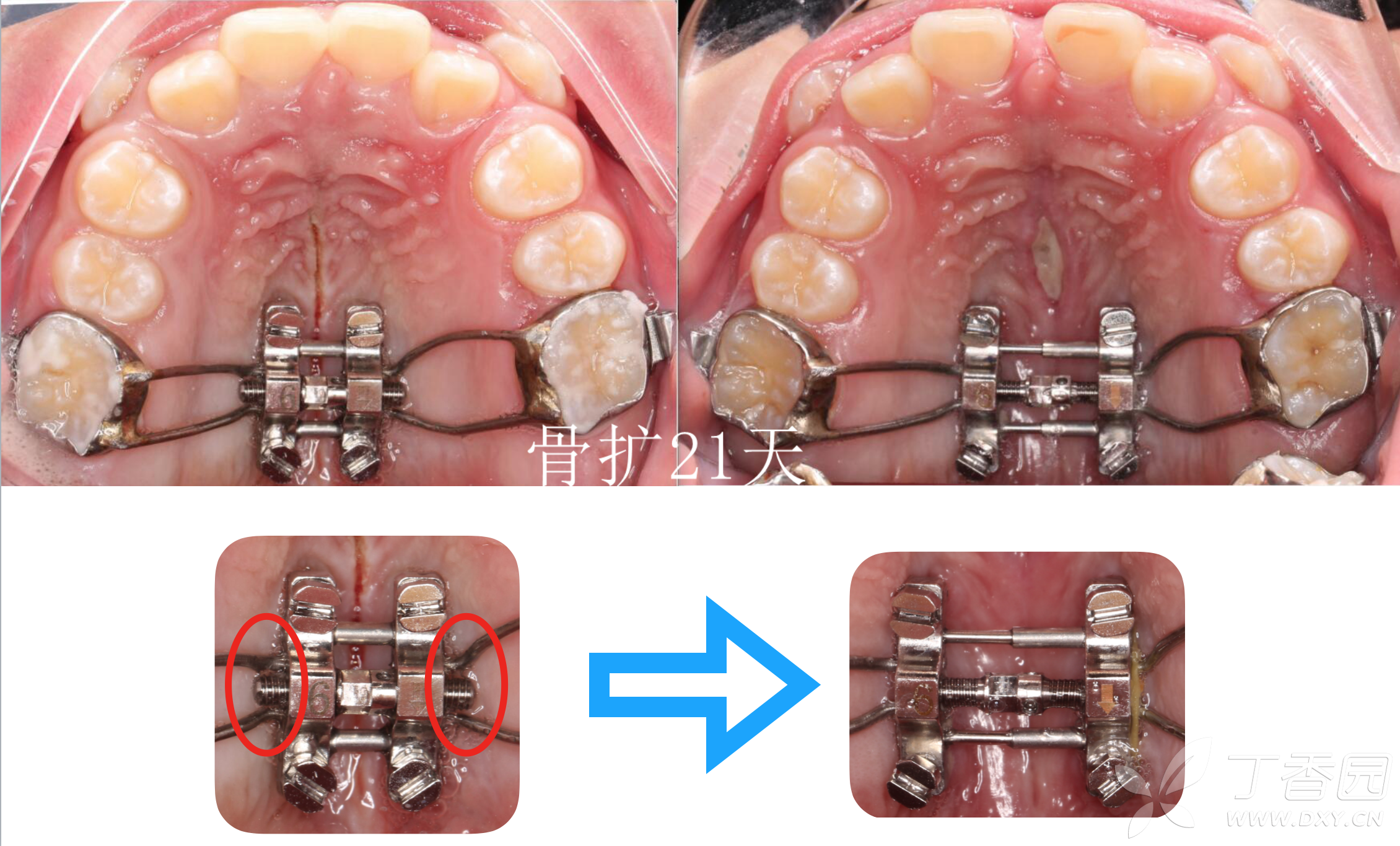 正畸临床病例