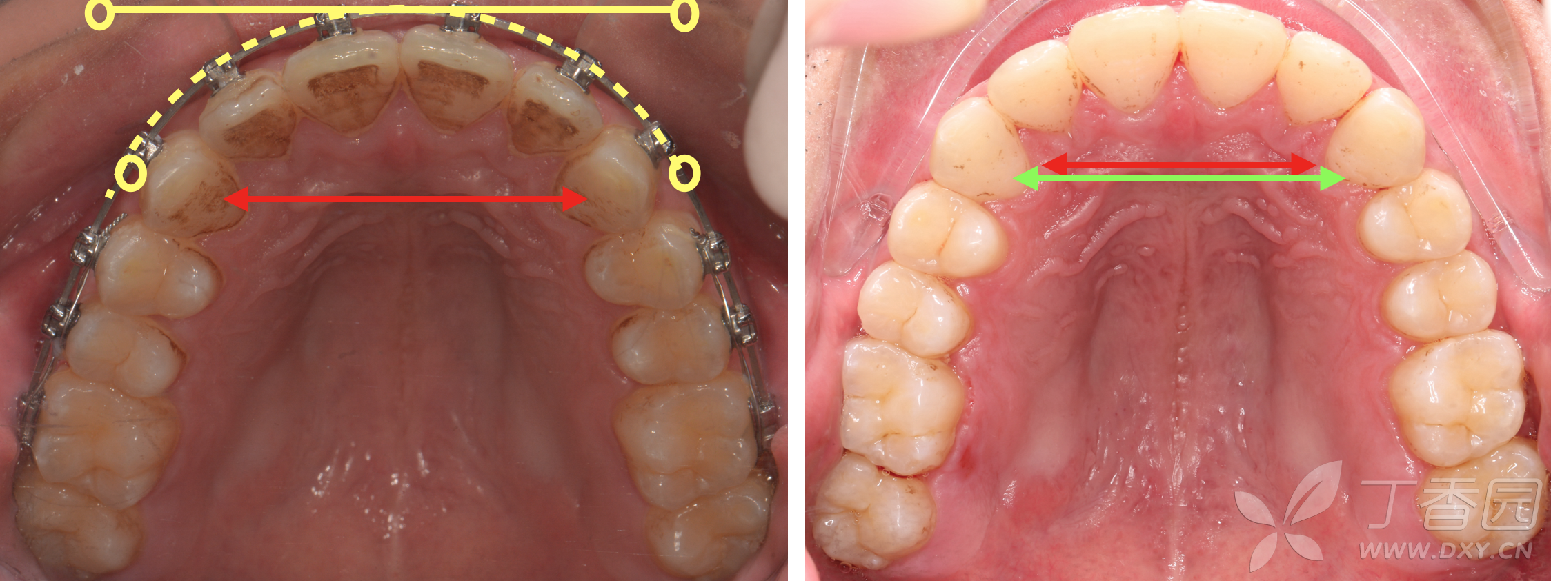 辅助粗弓丝扩弓
